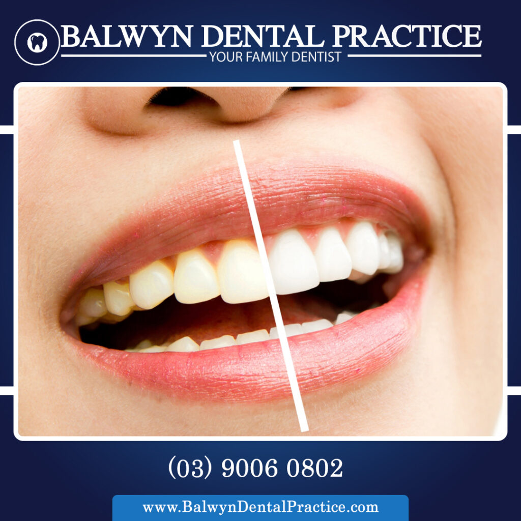 Teeth Whitening services.