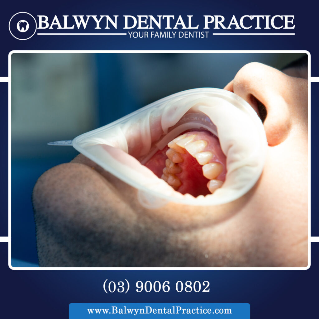 Zygomatic Implants
